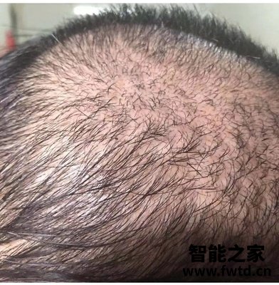 以色列veve生发仪有用吗?以色列veve生发仪到底怎么样?