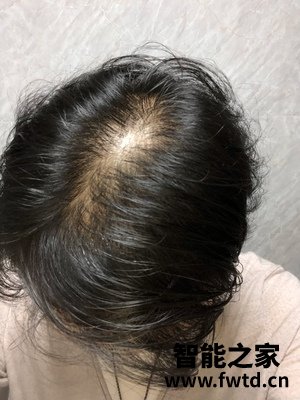 以色列veve生发仪有用吗?以色列veve生发仪到底怎么样?
